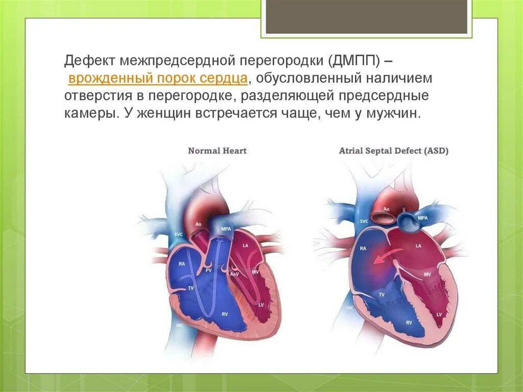 Аневризма перегородки у ребенка. Врожденный дефект межпредсердной перегородки. Врожденный порок сердца ДМПП. Порок сердца межпредсердной перегородки. Врожденный порок сердца дефект межпредсердной перегородки.