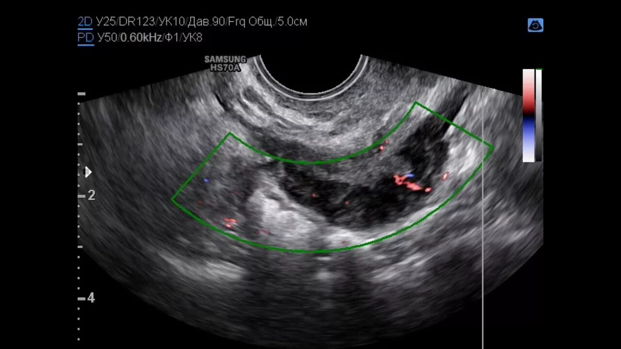 Эндометриоидная киста на УЗИ. Эндометриоз прямой кишки УЗИ. Эндометриоз виден на узи