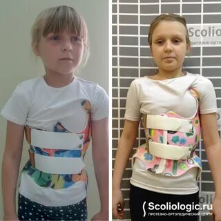 Турнера сколиоз