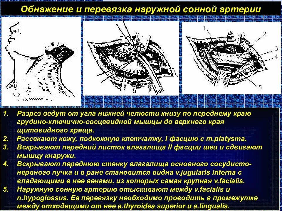 Операция на артерии шеи. Перевязка наружной сонной артерии топографическая анатомия. Перевязка лицевой язычной наружной сонной артерии. Операции на сонных артериях топографическая анатомия. Перевязка наружной сонной артерии операция.