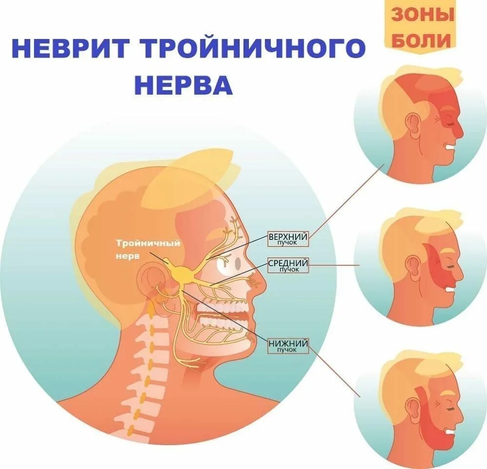 Простужен нерва. Тройничный лицевой нерв симптомы. воспаление тройничного нерва симптомы. невралгия тройничного нерва 1. оспалениетройничного нерва.