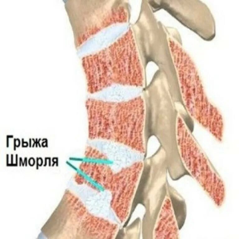 Что значит грыжа шморля. Грыжа шморля l1. грыжа шморля l1-l2. узелки шморля в позвоночнике. грыжа шморля шейного отдела позвоночника.