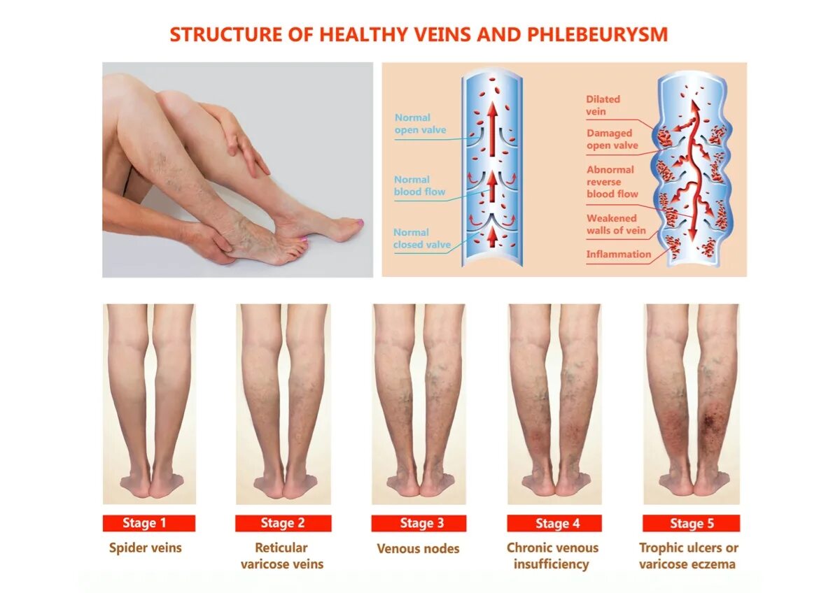 Тяжесть в ногах причины у мужчин. Варикозное расширение вен нижних конечностей классификация. Варикозно расширенные вены нижних конечностей классификация. Варикозное расширение вен стадии.