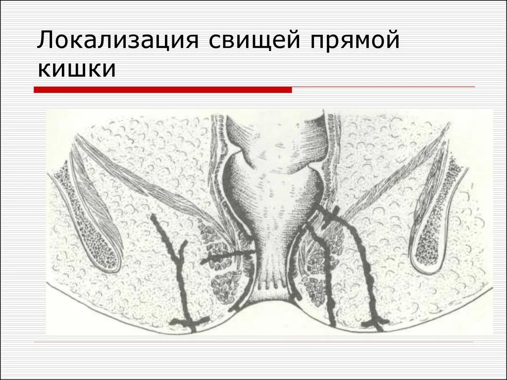Свищи кишечника после операции