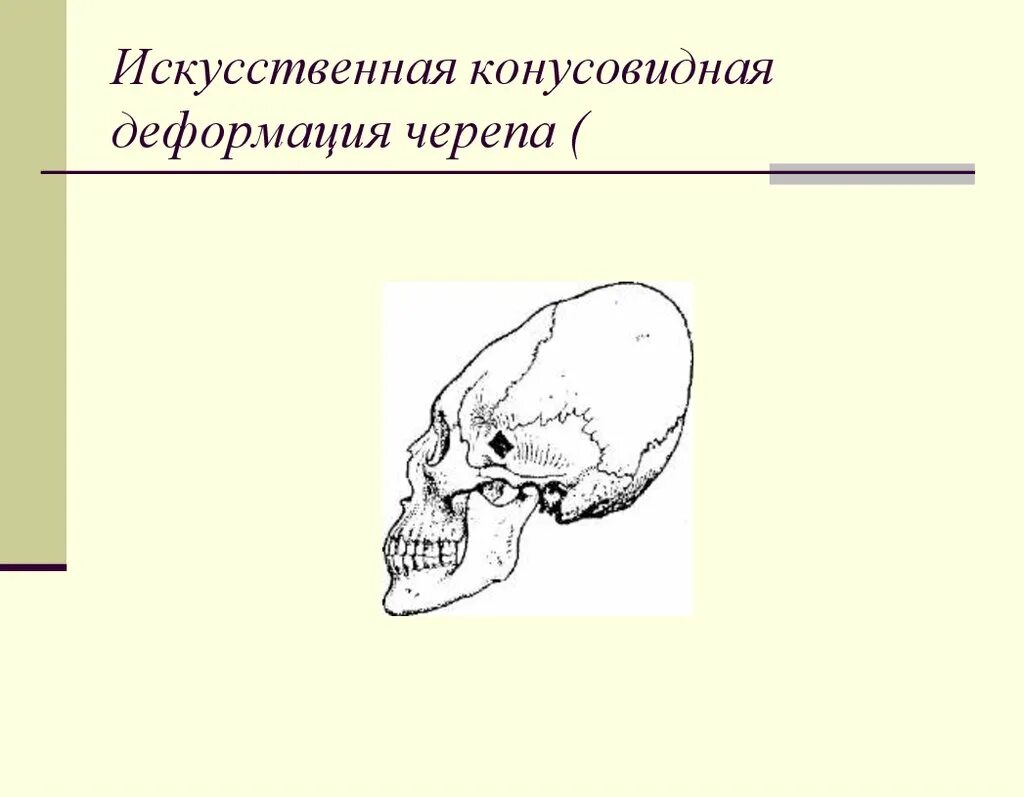 Деформация кости черепа. Искусственное деформирование черепа у.