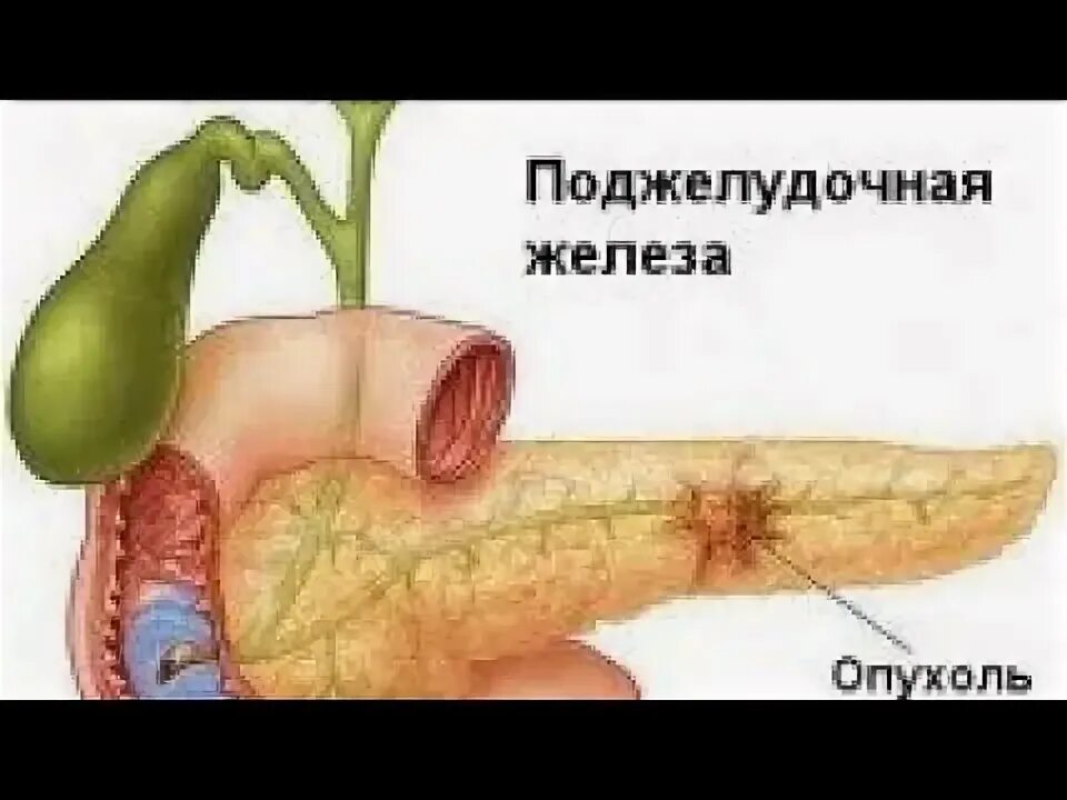 Как выглядит рак поджелудочной железы Рекомендуемая диета при раке поджелудочной