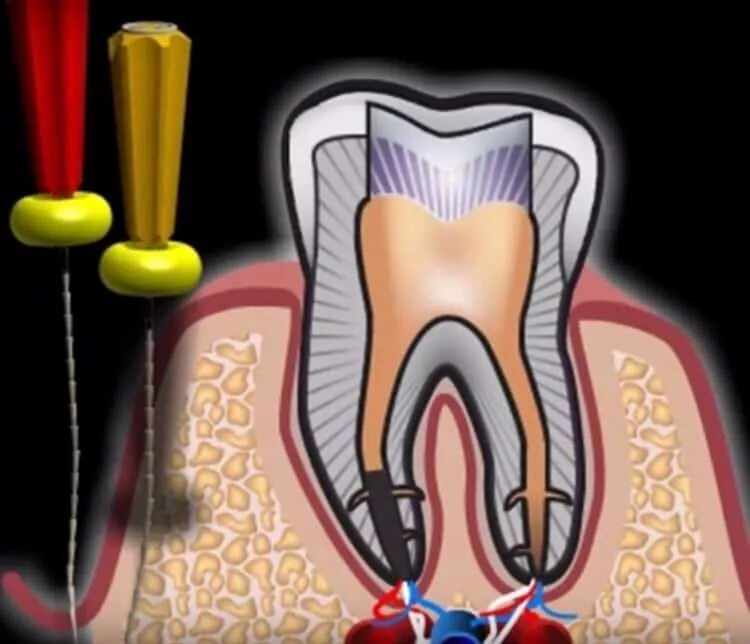 Воспаление канала зуба. Трехкорневой периодонтит. Периодонтит зуба периодонтит зуба. Периодонтит эндодонтия.