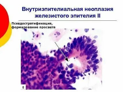 Пролиферация железистого эпителия nilm
