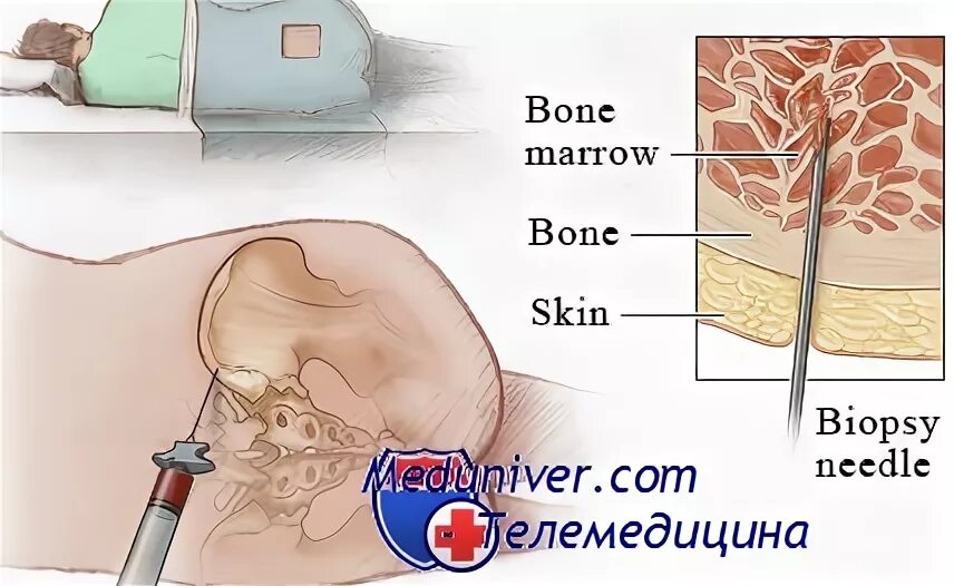 Трепанобиопсия кости. Трепанобиопсия костного мозга. Трепан биопсия костного мозга. Трепанобиопсия пунктат костного мозга. Трепан биопсия подвздошной кости.