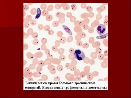 Тропическая малярия