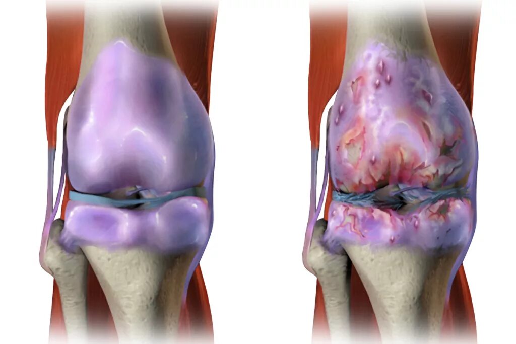 Остеоартроз (деформирующий остеоартроз). Остеоартрит коленного сустава. Деформирующий артроз (остеоартроз). Деформирующий артроз это остеоартрит. Что разрушает суставы