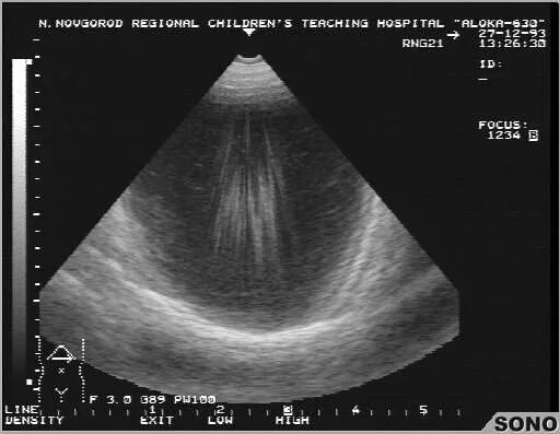 артефакт хвост кометы на узи. артефакты узи. акустическое усиление на узи. артефакты узи. эффект дистального псевдоусиления.