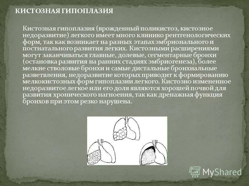 Рентгенологическая диагностика гипоплазии. Кистозная гипоплазия рентген. Гипоплазия почки на узи протокол. Дифференциальный диагноз гипоплазии почки. Дифференциальный диагноз гипоплазии почки.