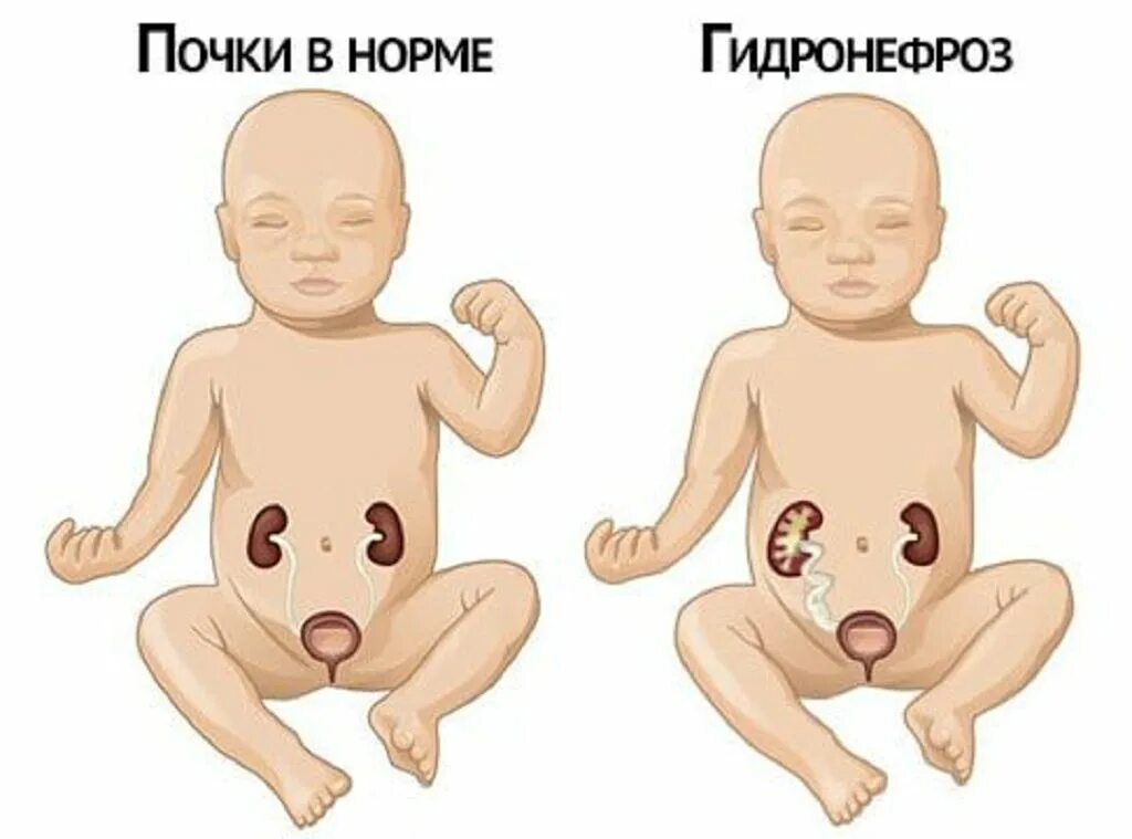 Гидронефроз почки у эмбриона. Врожденный гидронефроз у детей. Гидронефроз почки у младенца.