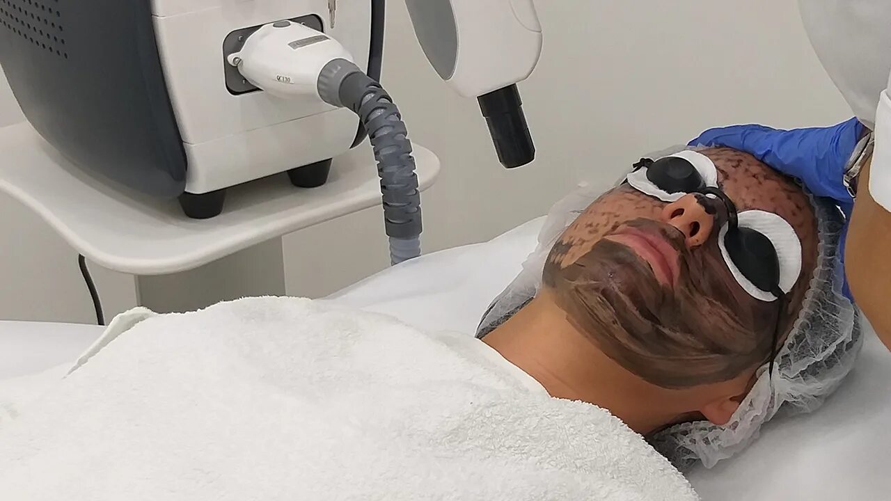 карбоновый пилинг противопоказания. карбоново лазер пилинг. карбоновый пилинг аппарат pico 2. карбоновый пилинг противопоказания. лазерно карбоновый пилинг.