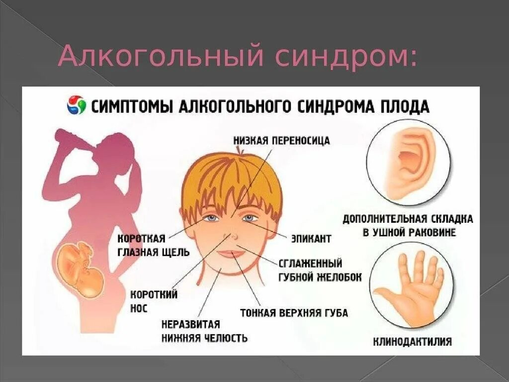 Фетальный алкогольный синдром. Признаки алкогольного синдрома плода. Дети алкоголиков внешние признаки синдрома. Фетальный алкогольный синдром патогенез. Синдром главного героя это