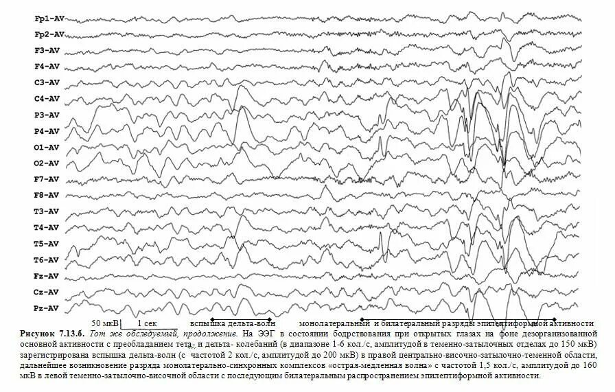 Ээг дельта. Вертексные волны на ЭЭГ. Вертексные потенциалы на ЭЭГ. Волны на ЭЭГ расшифровка. Сонные веретена и к-комплексы на ЭЭГ.