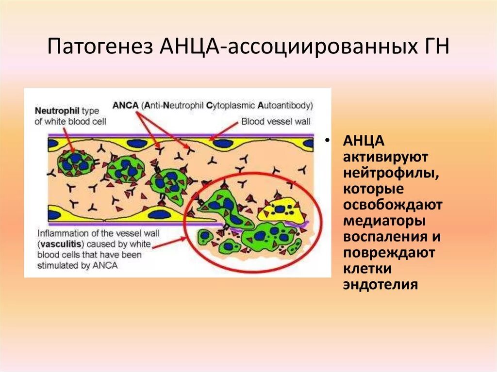 Васкулит патогенез. АНЦА васкулит патогенез. АНЦА-ассоциированные васкулиты патогенез. АНЦА патогенез. Антинейтрофильные цитоплазматические аутоантител (АНЦА.