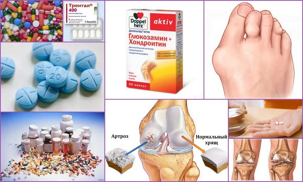 Таблетки от артрита суставов. Таблетки от остеоартроза. Препараты при остеоартрозе суставов. Таблетки для артроза коленного сустава. Лечение артрита и артроза препараты