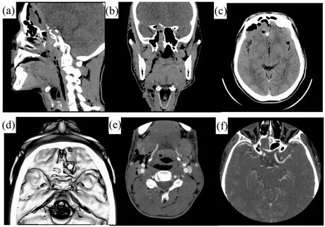 Ms ct