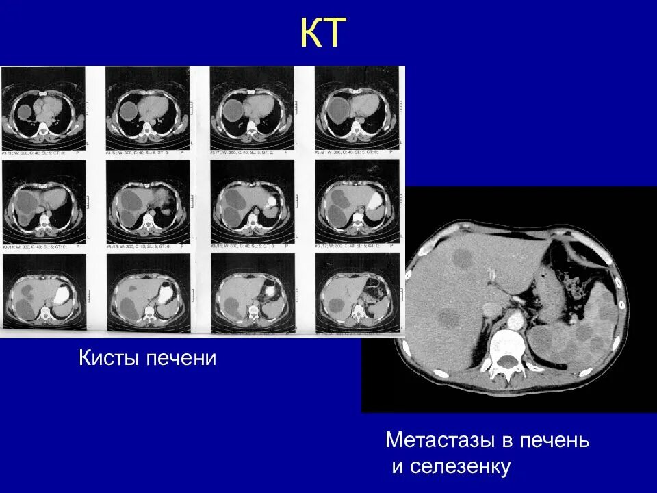 Как отличить метастазы