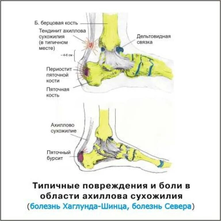 Тендинит ахиллова сухожилия рентген. Место прикрепления ахиллова сухожилия к пяточной. Пяточная шпора ахиллова сухожилия рентген. Ахиллова шпора левой пяточной кости. Почему болят сухожилия пятки