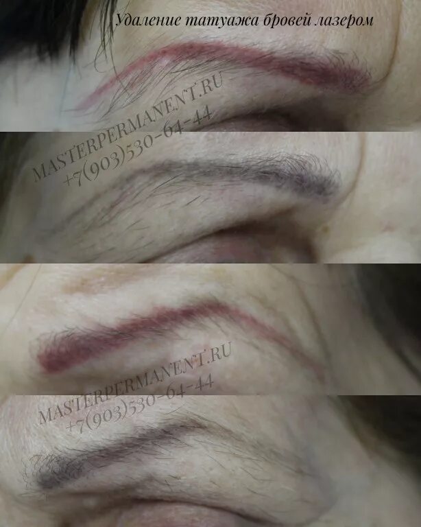 удаление лазером красных бровей. удаление лазером красных бровей. брови после удаления перманентного макияжа. удаление лазером красных бровей.
