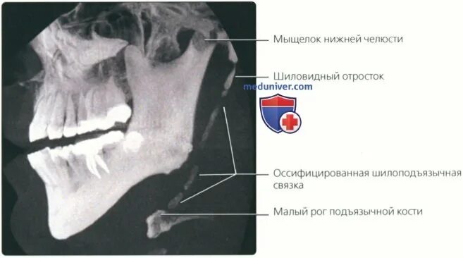 Шиловидный отросток анатомия. Лучезапястный сустав гороховидная кость. Шиловидный отросток лучезапястного сустава. Шиловидный отросток анатомия. Шиловидный отросток анатомия.