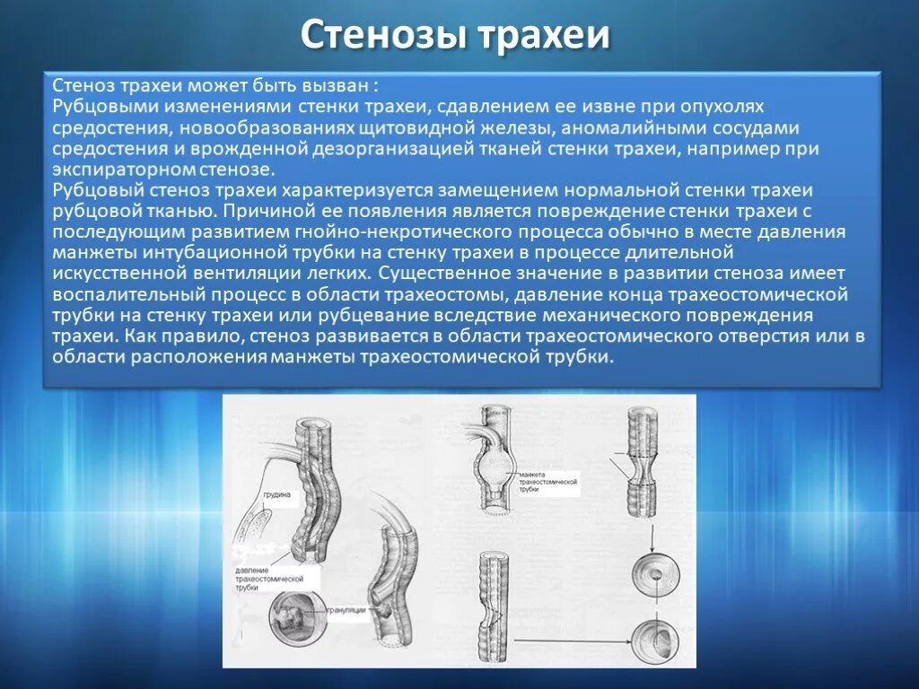 Стеноз инвалидность. Рубцовый стеноз трахеи. Стеноз трахеи классификация. Врожденный стеноз трахеи.