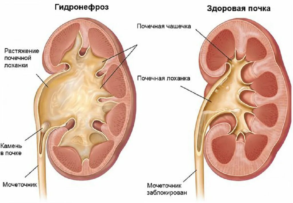 Дилатация мочеточника. Врожденный гидронефроз почки. Гидронефроз левой почки 2ст. Строение почки гидронефроз анатомия. Врожденный гидронефроз левой почки.