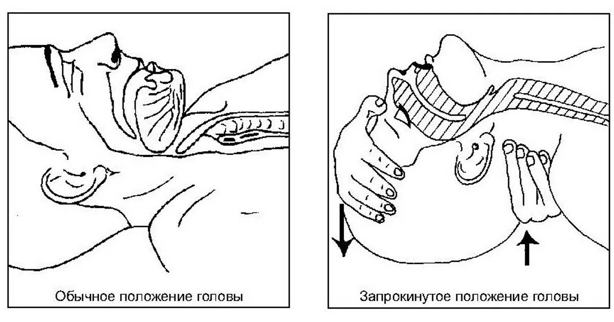 Проходимость дыхательных путей алгоритм. Обеспечение проводимости верхних дыхательных путей.. восстановление проходимости дыхательных путей при слр. слр обеспечение проходимости дыхательных путей. обеспечение проходимости вдп.
