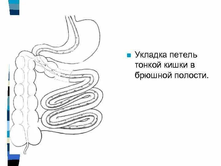 Петли Толстого кишечника. Расположение петель тонкого кишечника. Раздутая петля кишечника. Расширение петель кишечника