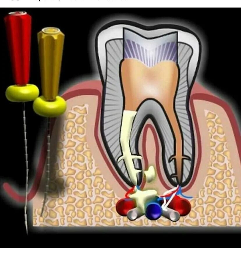 Перфорация стенки корневого канала. Перфорация эндодонтия. Перфорированный корень зуба. Осложнения эндодонтического лечения