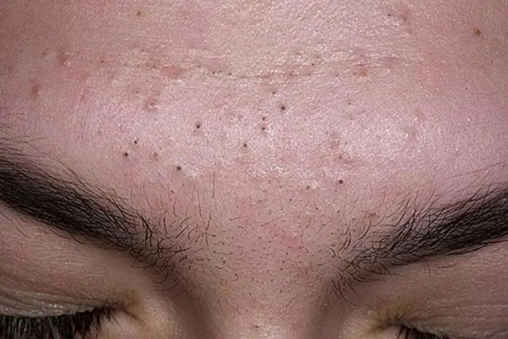 Лицо с расширенными порами. Фолликулярные комедоны. Какие бывают поры. Какие бывают поры. Какие бывают поры.