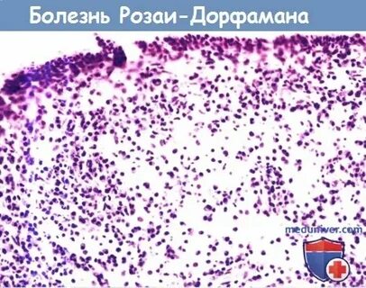 Болезнь розаи дорфмана что
