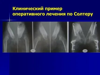 Врожденные заболевания костей