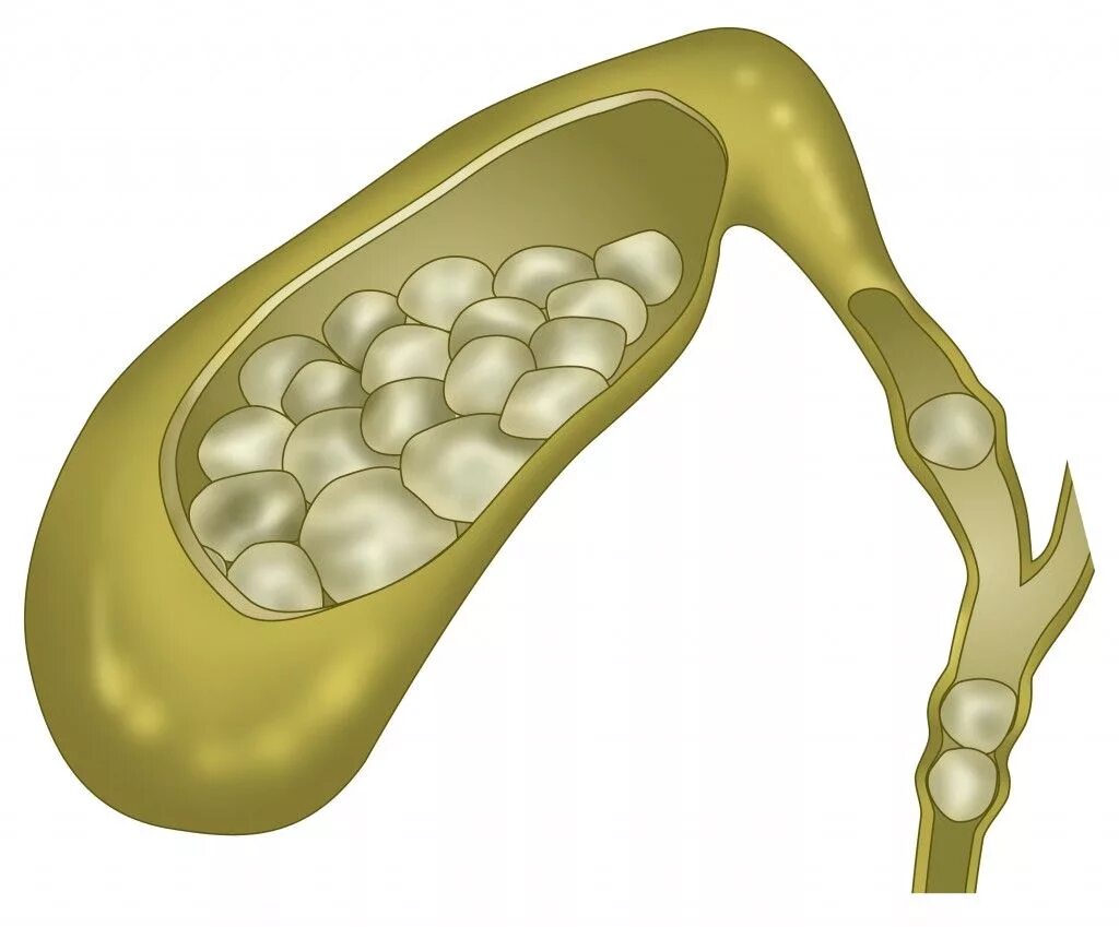 Желчный камень в кишечнике. ЖКБ камни желчного пузыря. Желчекаменная болезнь холелитиаз. Желчекаменная болезнь конкременты. Желчнокаменная болезнь холестериновые камни.