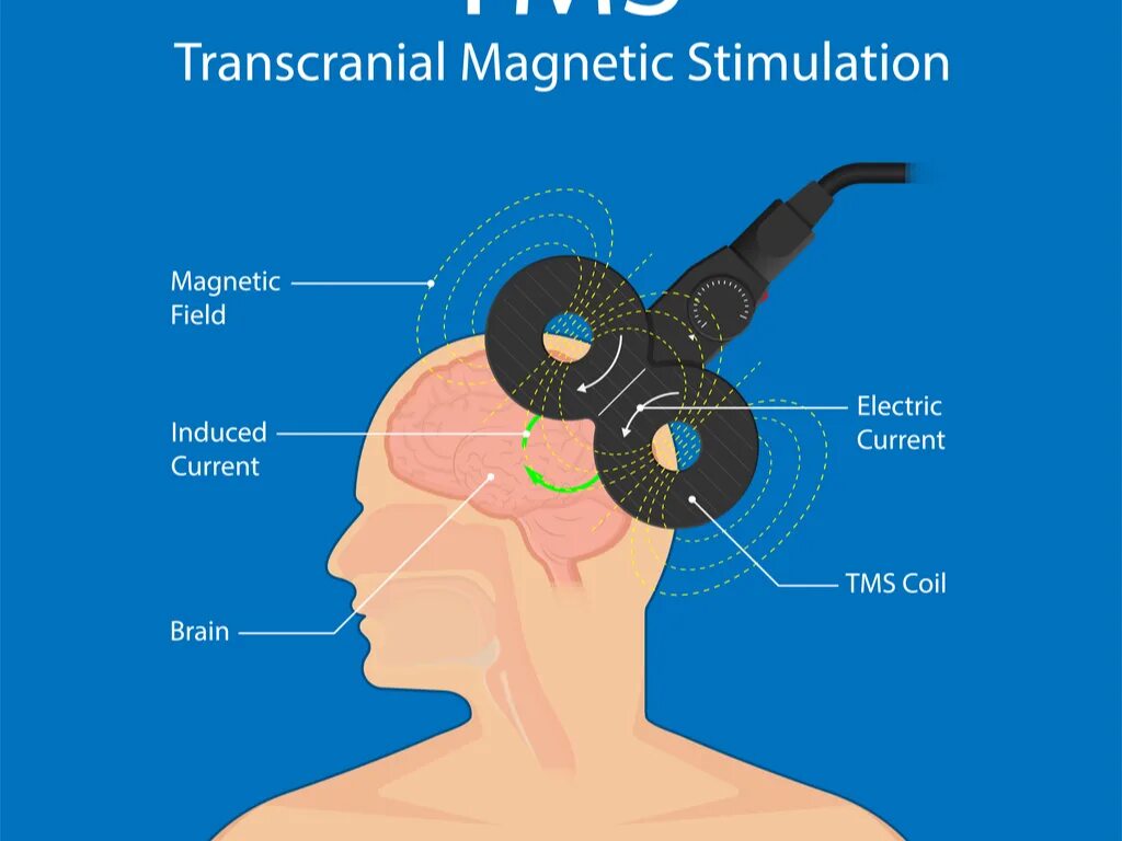 Тмс транскраниальная магнитная. Transcranial magnetic stimulation. тмс транскраниальная магнитная стимуляция. 1. транскраниальная магнитная стимуляция (tms):. tms coil.