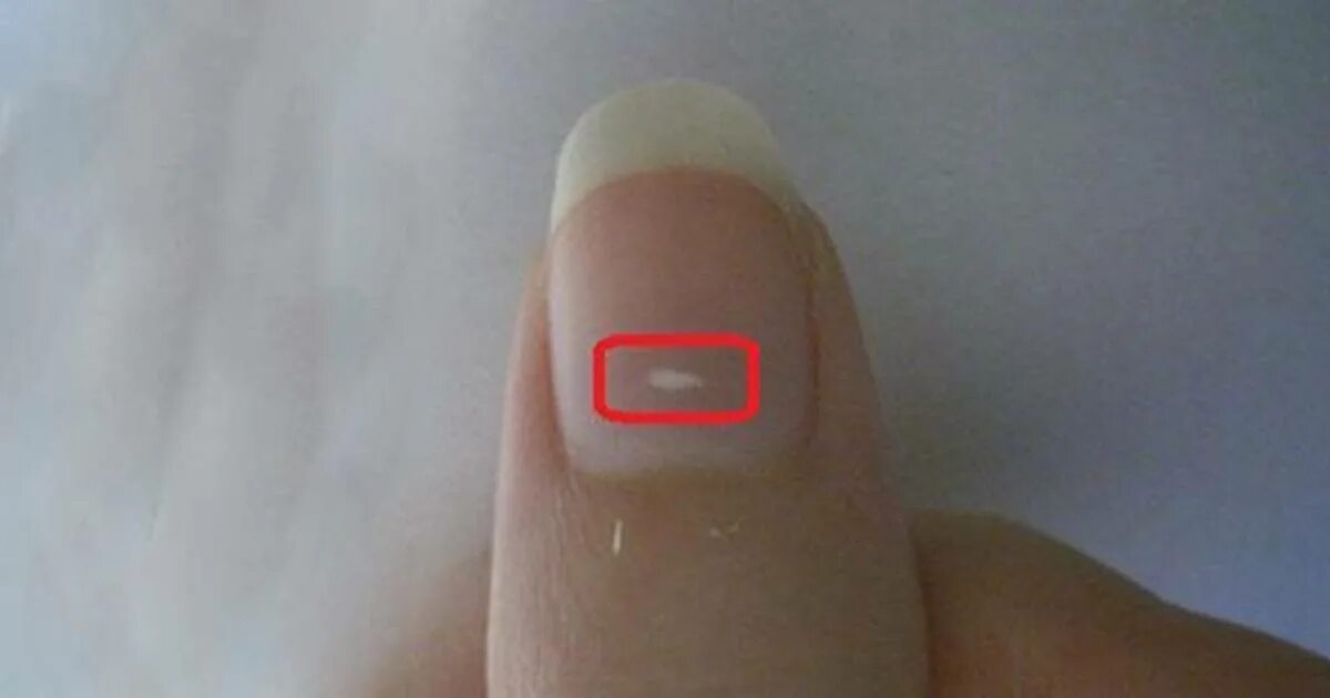 Что означают белые пятна на ногтях рук. Белое пятно на ногте большого пальца.