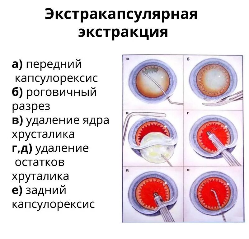 Операция катаракты сколько по времени. Интракапсулярная экстракция. К современным методам удаления катаракты относят. Экстракапсулярная экстракция ядра хрусталика. Интракапсулярной экстракции катаракты.