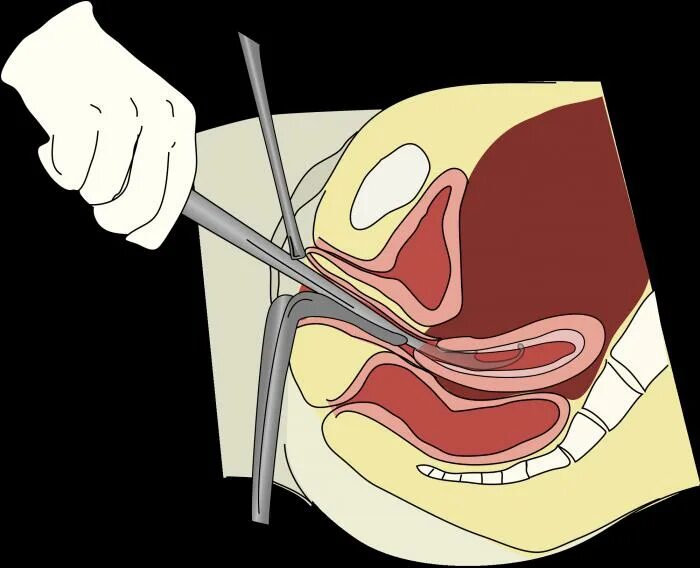 Выскабливание полости матки РДВ. РДВ шейки матки гистероскопия. Выскабливание слизистой оболочки матки. Кюретаж выскабливание.