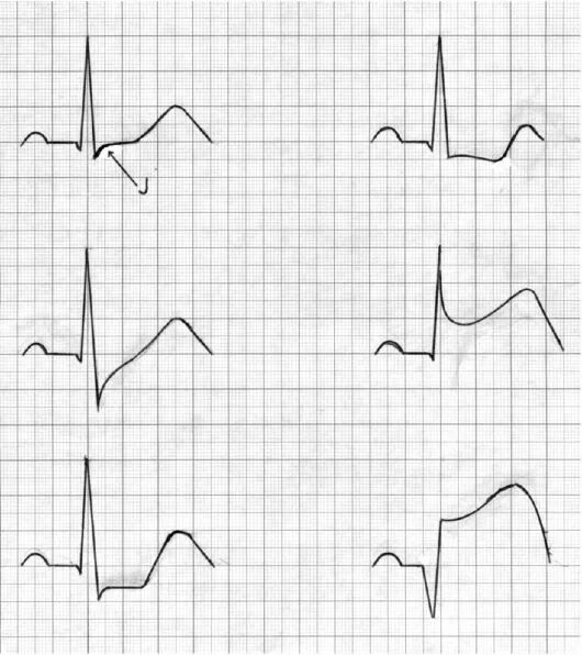 Депрессия сегмента st. Подъем сегмента St на ЭКГ v3. Косонисходящая депрессия сегмента St на ЭКГ. Депрессия и элевация сегмента St. Подъем St на ЭКГ v1-v2.