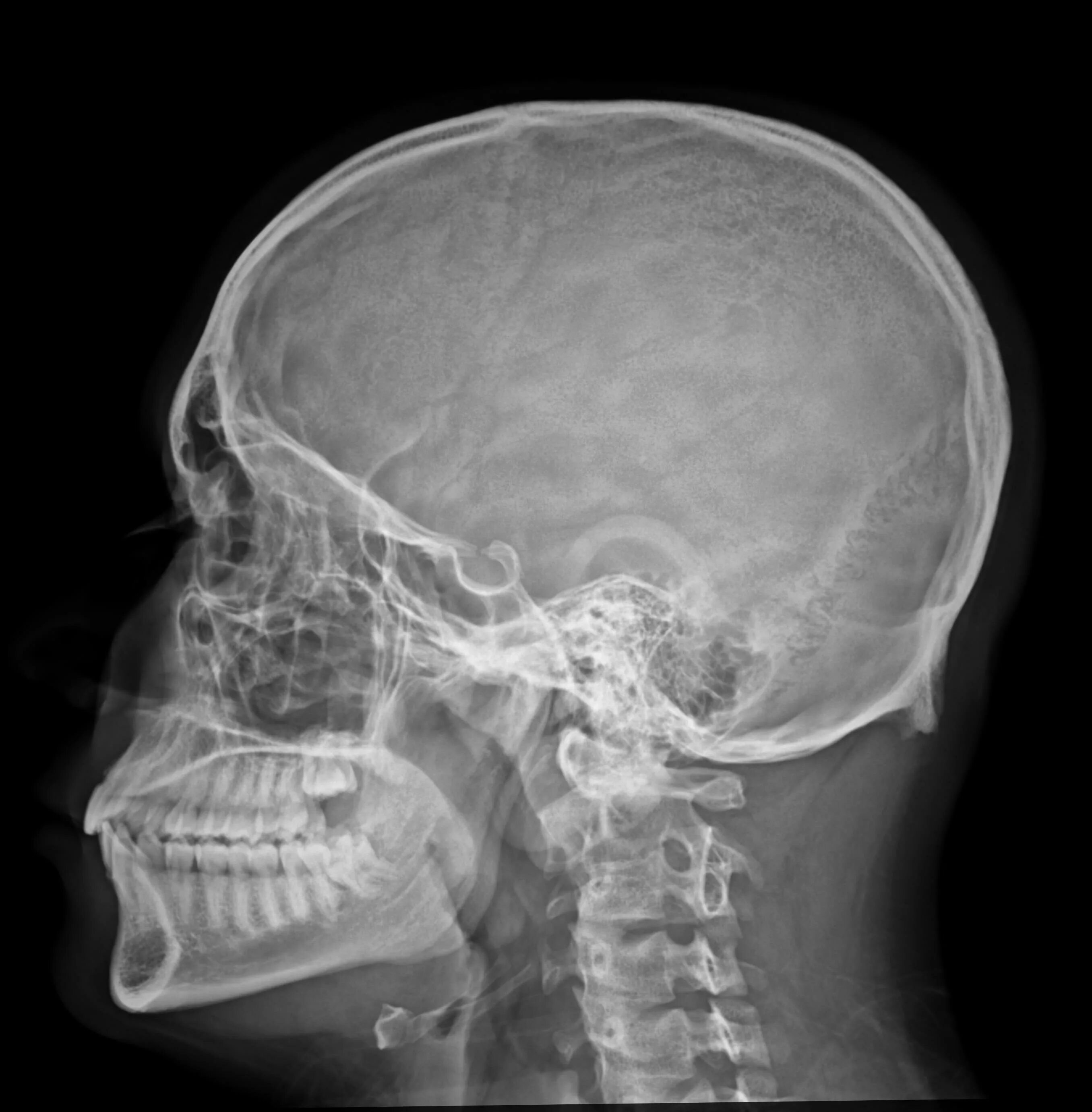 Обызвествление шишковидной железы рентген черепа. Обызвествление шишковидной железы рентген. Рентген затылочной кости черепа.