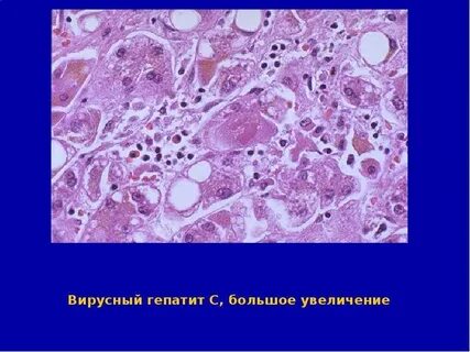 Гранулеза