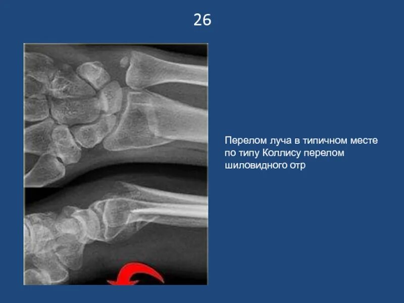 Перелом луча в типичном месте код мкб. Перелом смита рентгенограмма. перелом луча в типичном месте рентген. перелом коллиса рентген.