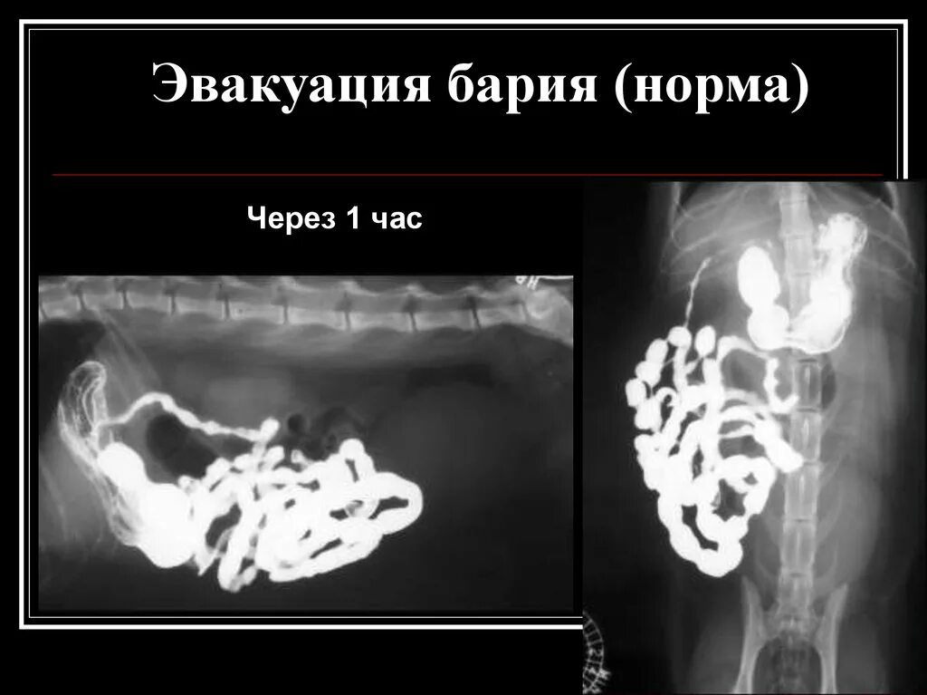 Рентгенография с барием норма.