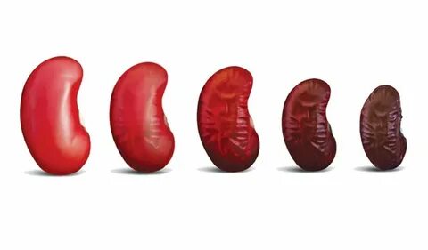Chronic kidney disease