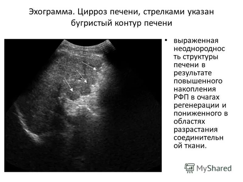 Микронодулярный цирроз печени УЗИ. Билиарный цирроз печени УЗИ. УЗИ признаки цирроза печени описание. Мелкоузловой цирроз на УЗИ. Структурные изменения печени