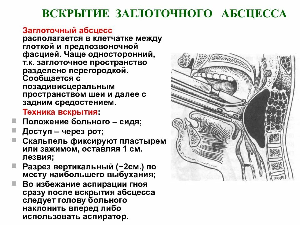 Spatium retropharyngeum. Заглоточный абсцесс топографическая анатомия. Вскрытие ретрофарингеальных флегмон. Схема вскрытия паратонзиллярного абсцесса. Вскрытие заглоточного абсцесса осложнения.