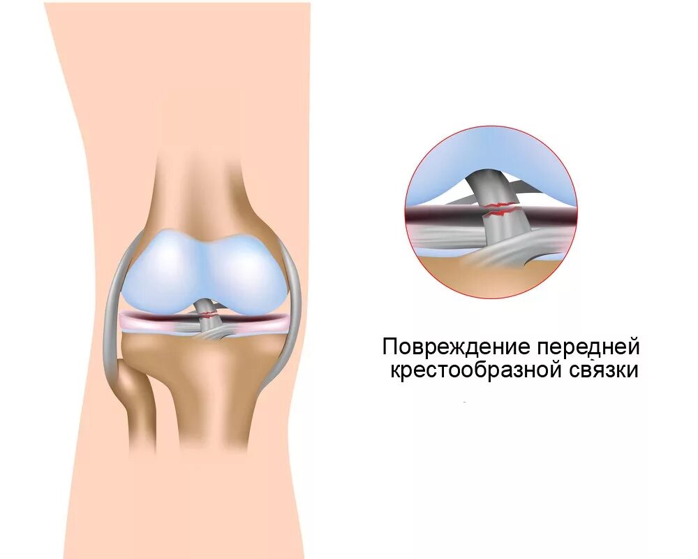 Разрыв передней крестообразной связки коленного. Разрыв крестообразной связки коленного сустава. Пластика передней крестообразной связки коленного сустава.
